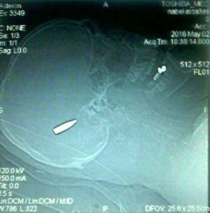 صورة الأشعة تظهر الرصاصة في رأس الدكتور نبيل الدعاس