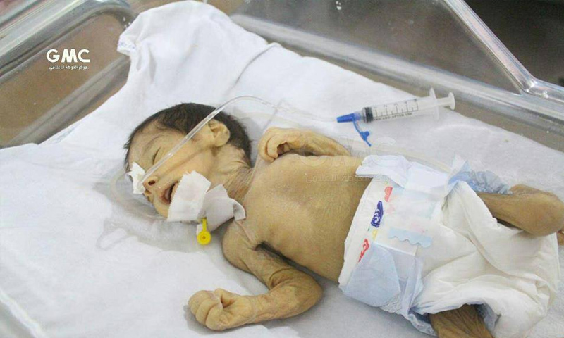 الطفل عبيدة الذي توفي في الغوطة الشرقية بسبب سوء التغذية - 21 تشرين الأول - (مركز الغوطة الإعلامي)