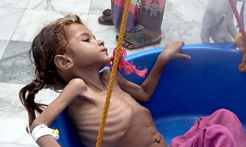طفلة تعاني من الجوع في اليمن (AFP)