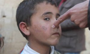طفل سوري مصاب بمرض 