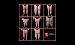 مرض اللبيديما (lipedema.org)