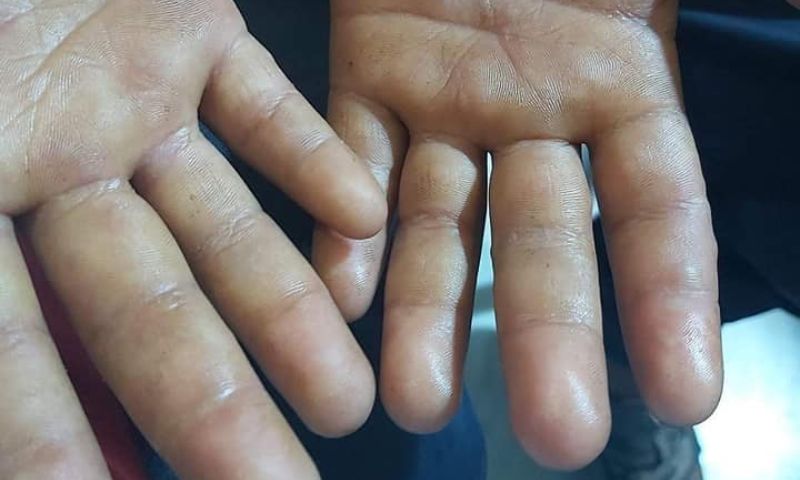 يدا طفل مصاب بمرض جدري الماء في مدينة الدانا بريف إدلب (متداول)