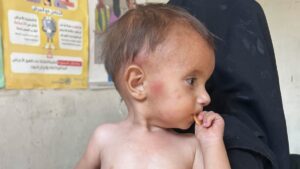 أم وطفلها ينتظران في عيادة طبية لعلاج سوء التغذية في حلب - 4 تشرين الثاني 2025 (الأمم المتحدة)