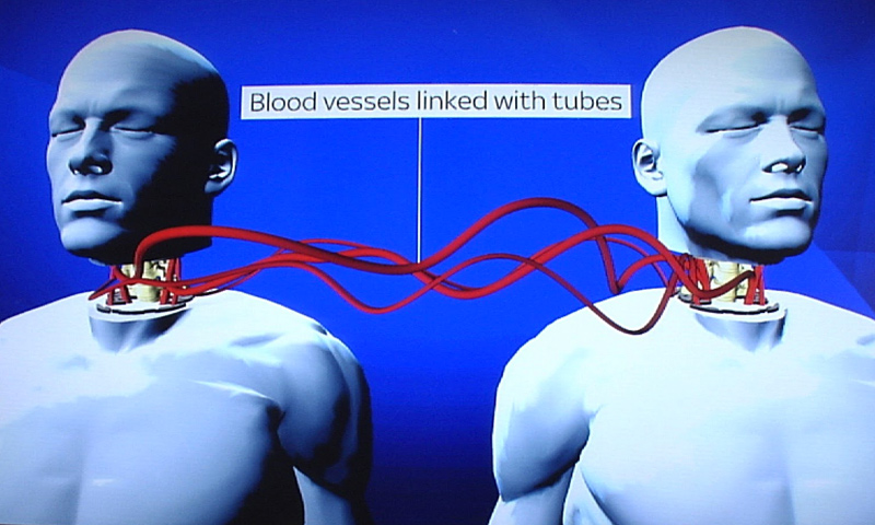 An illustration of the surgery’s procedures (Sky News)