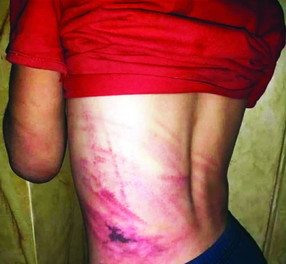 Marks of beating on Qusay al-Quoz’s body by his employer at the blacksmith shop in al-Tall- July, 2019