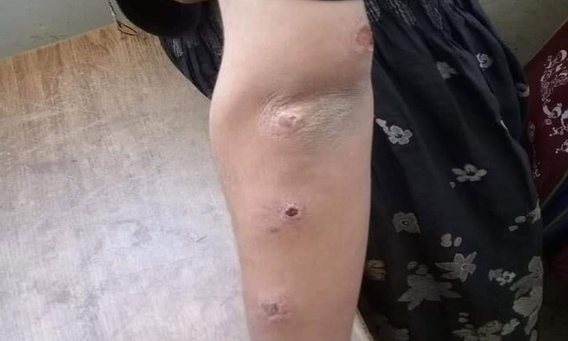 Leishmaniasis spreading among children of Deir Ezzor, November 2019 (Tawasol Deiry network on Facebook)