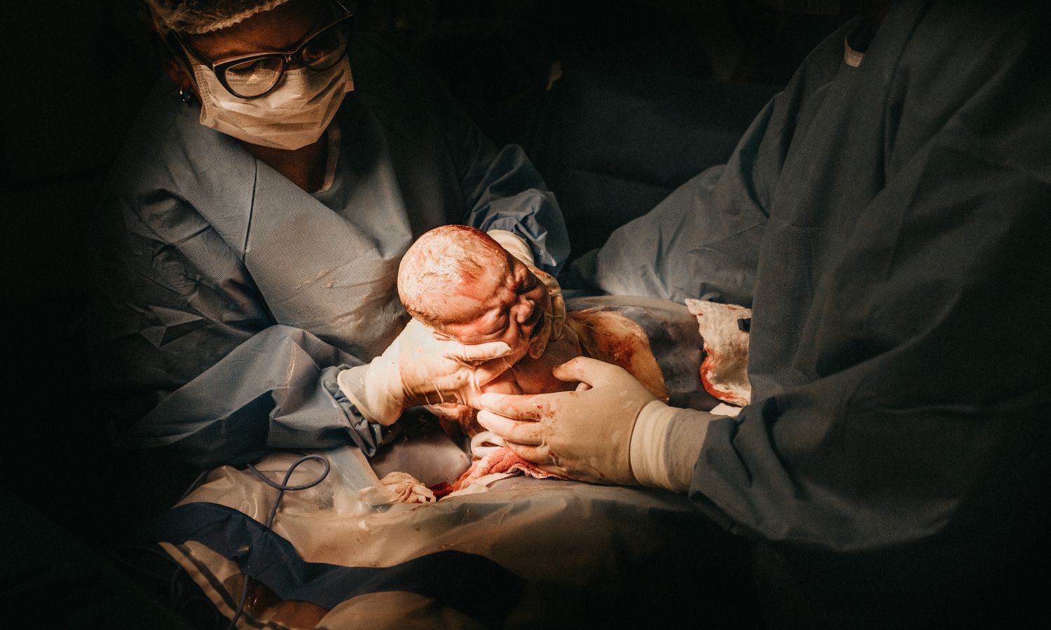 A Caesarean section operation (Canva)