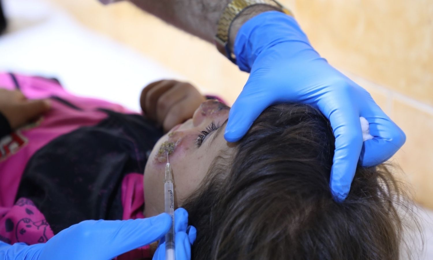 A child being treated for leishmaniasis in Idlib, September 18, 2023 (Idlib Health Directorate/Facebook)