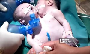 Birth of conjoined twins in Ras al-Ain - April 23, 2025 (Enab Baladi)